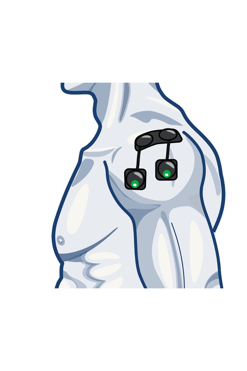 2 channel shoulder electrode placement for women with wireless Compex EMS muscle stimulator