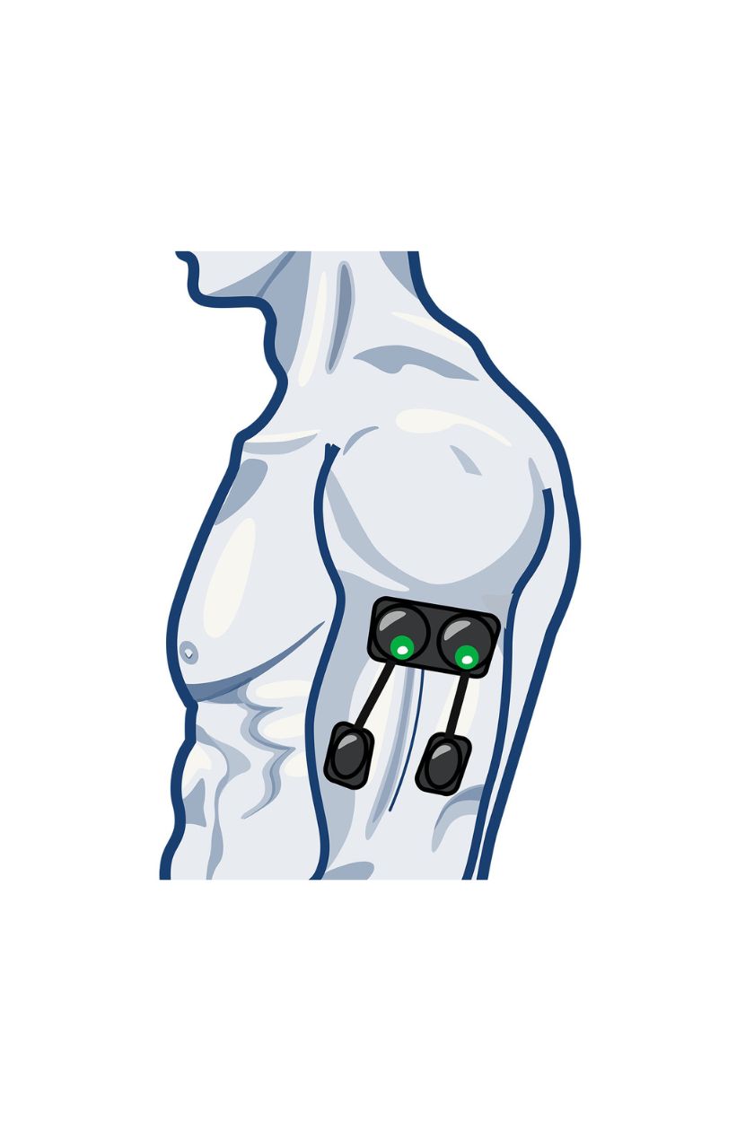 Upper arm electrode placement for women with wireless Compex EMS muscle stimulator