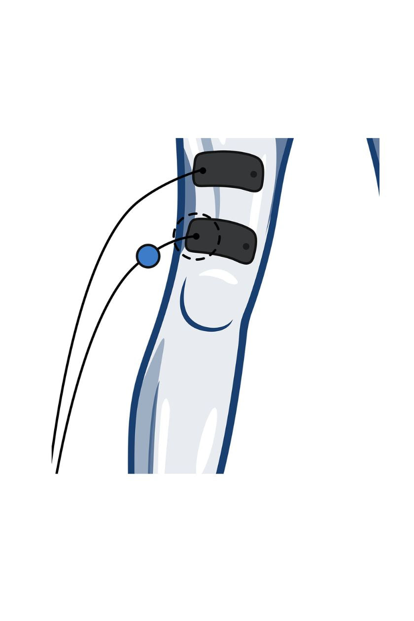 Quad (low) electrode placement for women with wired Compex EMS muscle stimulator