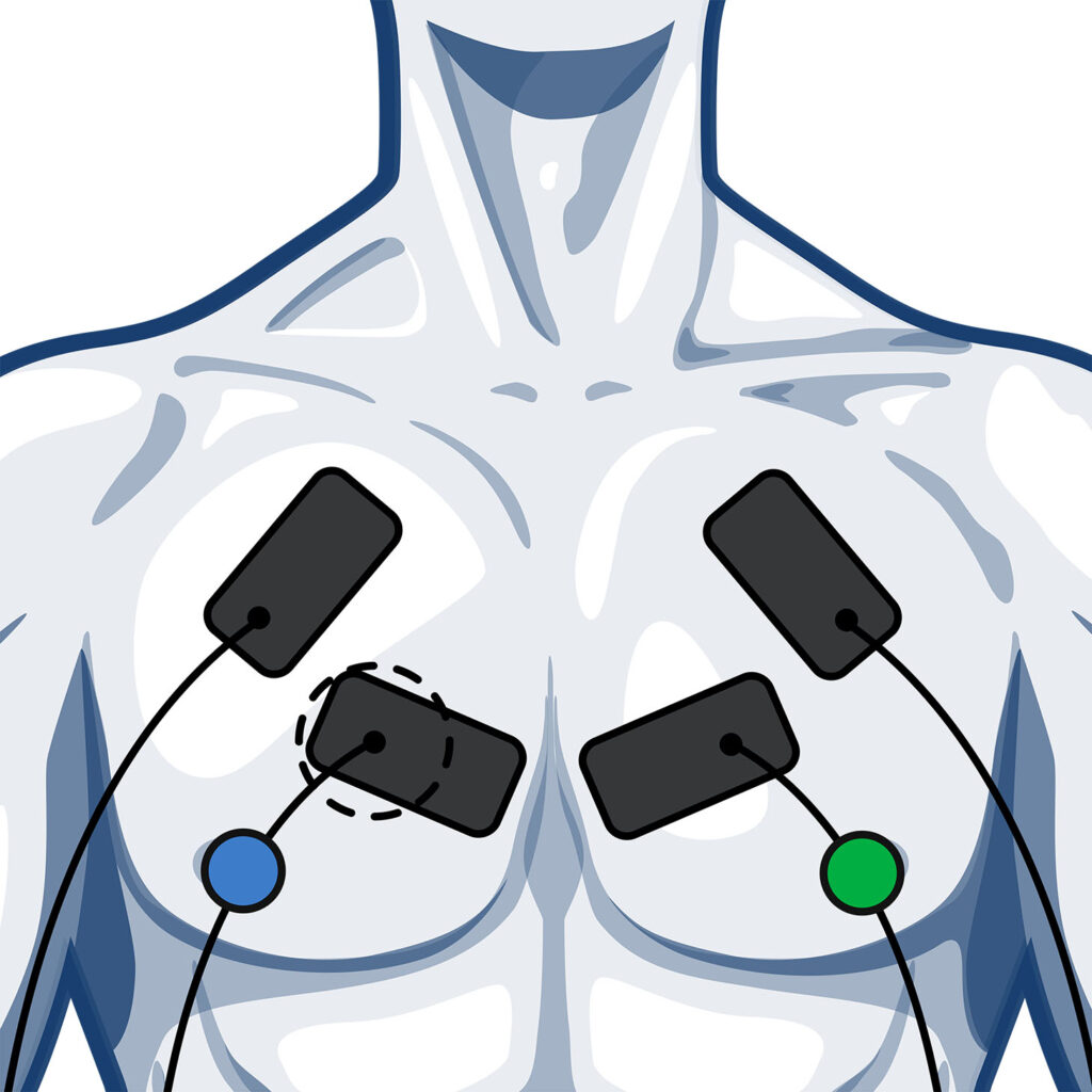 Platzierung der Elektroden auf den Brustmuskeln