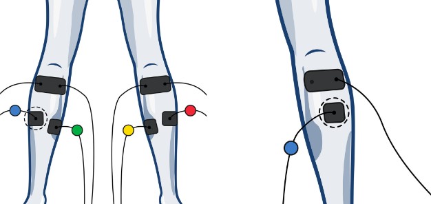 Wired Electrode Placement for the Calf