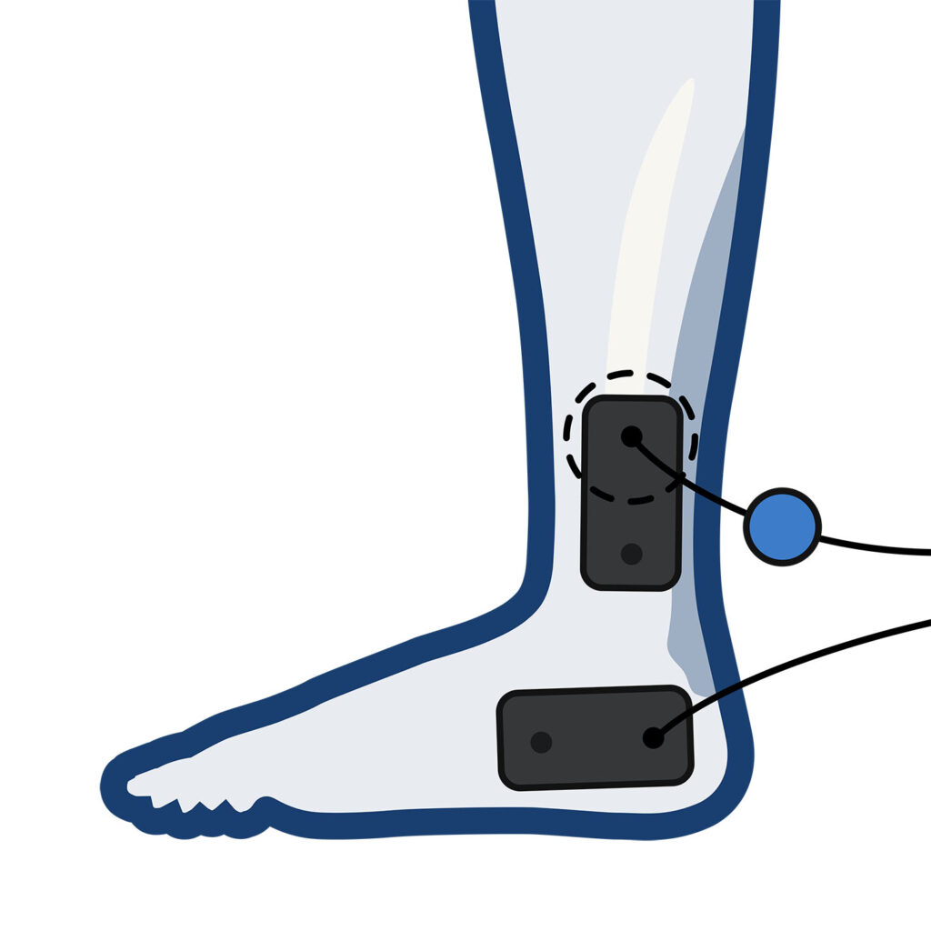 Wired Electrode Placement for the Ankle