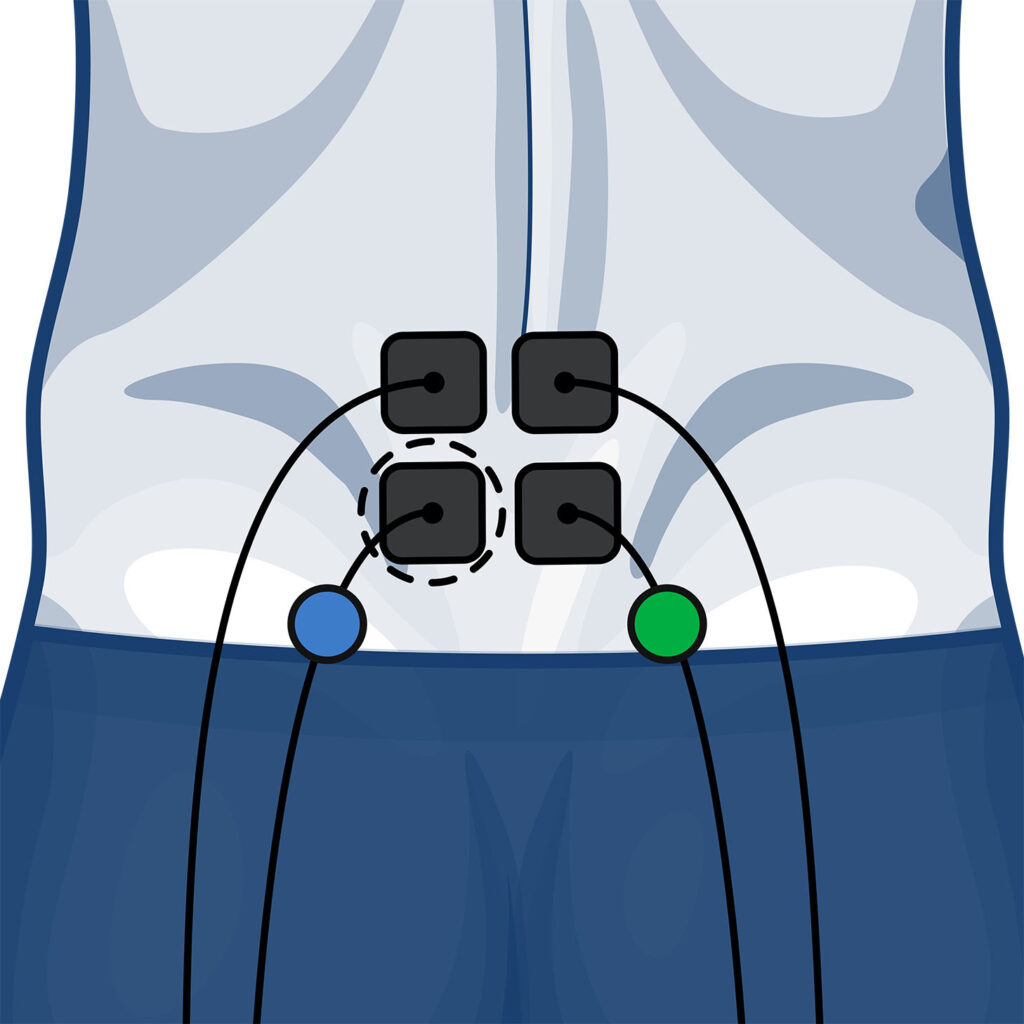Electrode Placement for the Lower Back on a wired Compex device