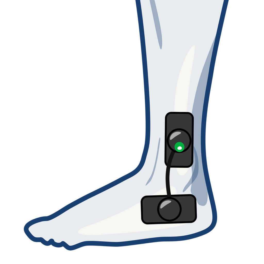 Wireless Electrode Placement for the Ankle