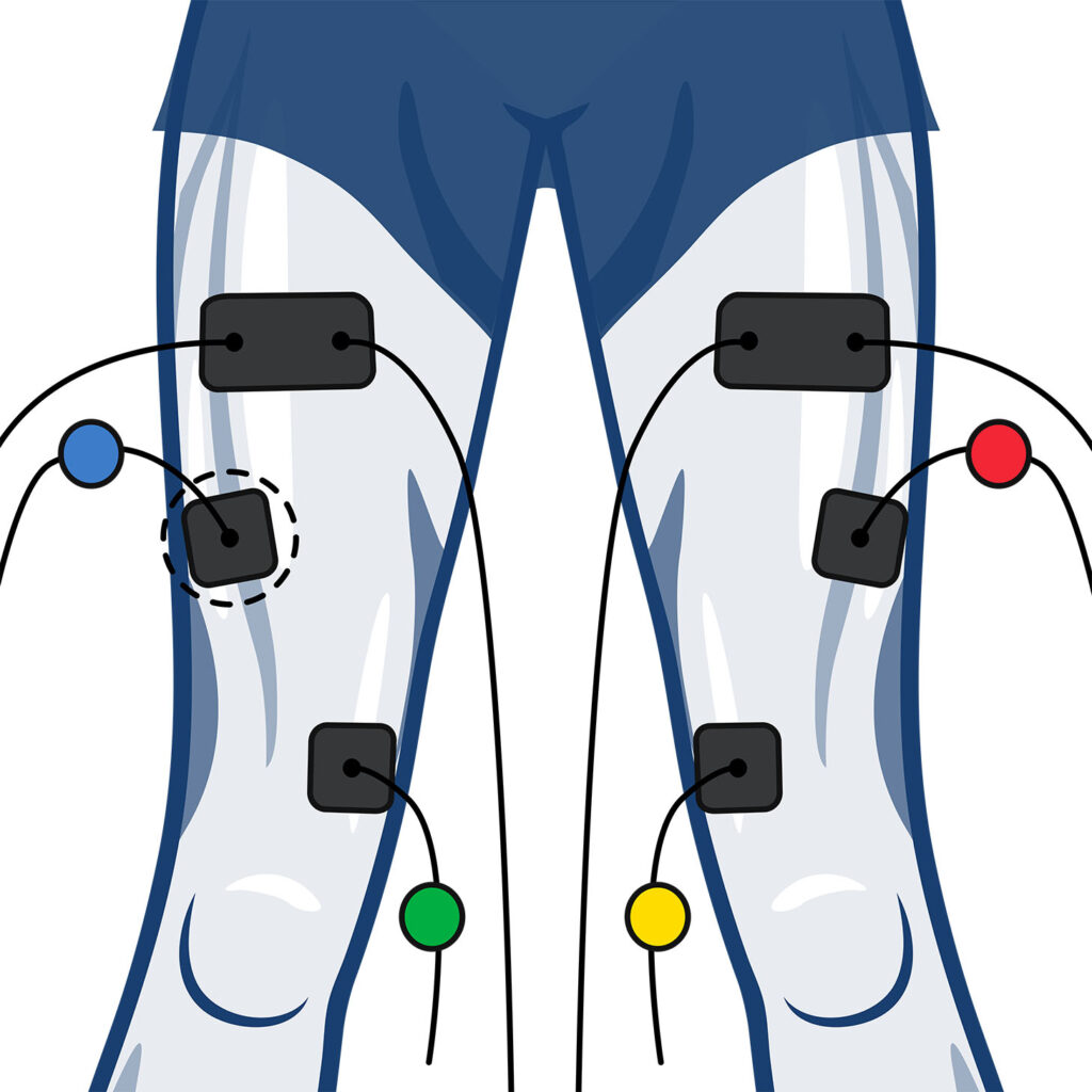 Wired electrode placement for quads