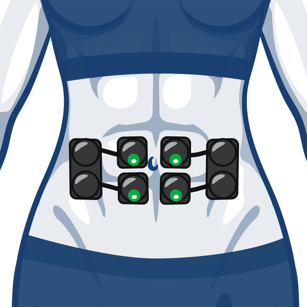Wireless electrode placement for the abs