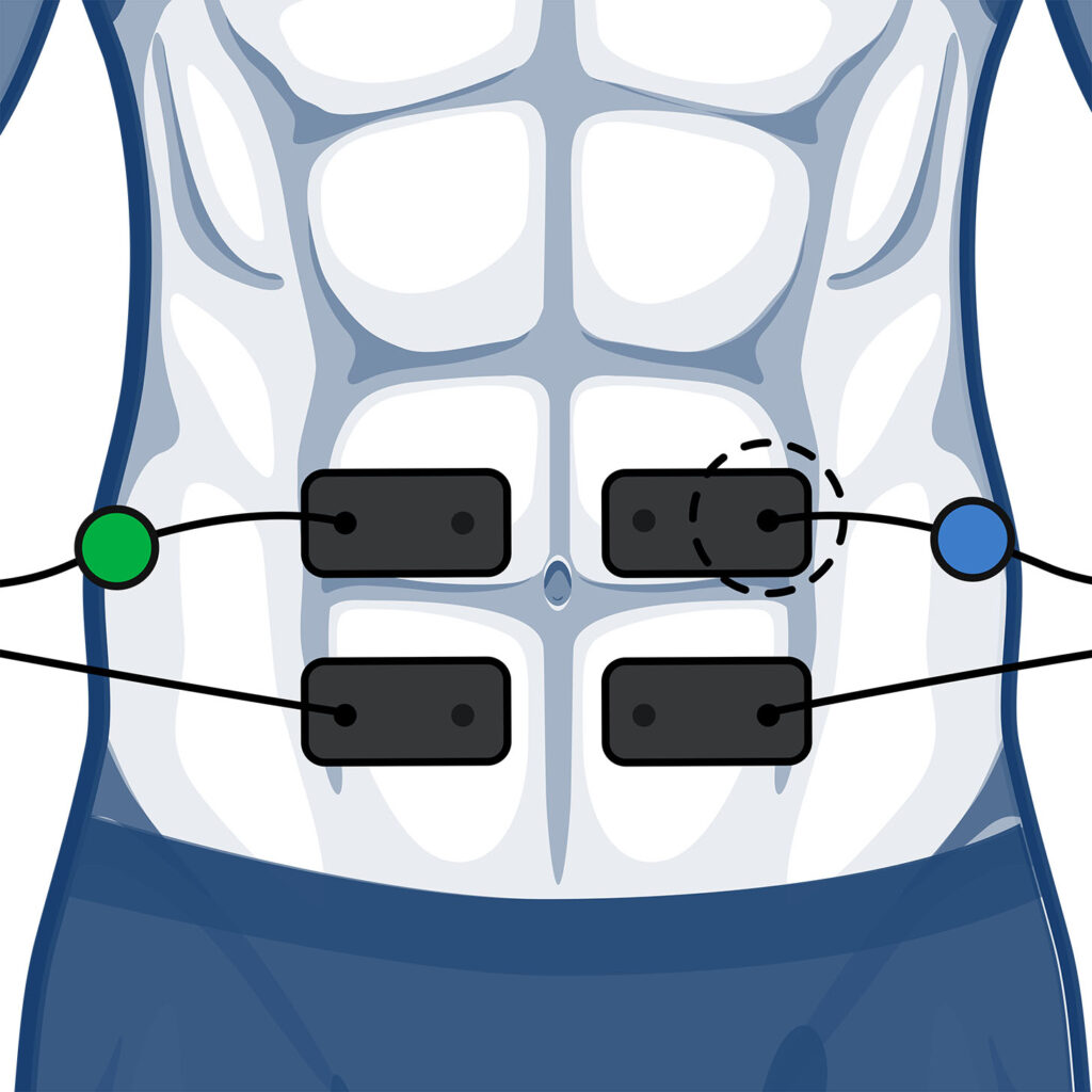Stomach electrode placement for wired muscle stimulators using 2 channels