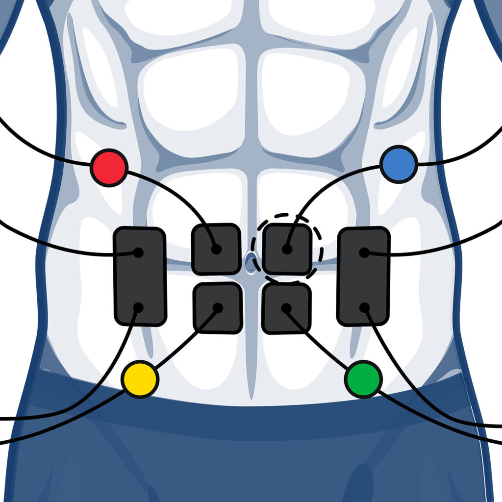 Stomach electrode placement for wired muscle stimulators using 4 channels