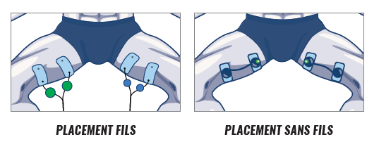 Traitement de la pubalgie avec l'électrostimulation | Compex