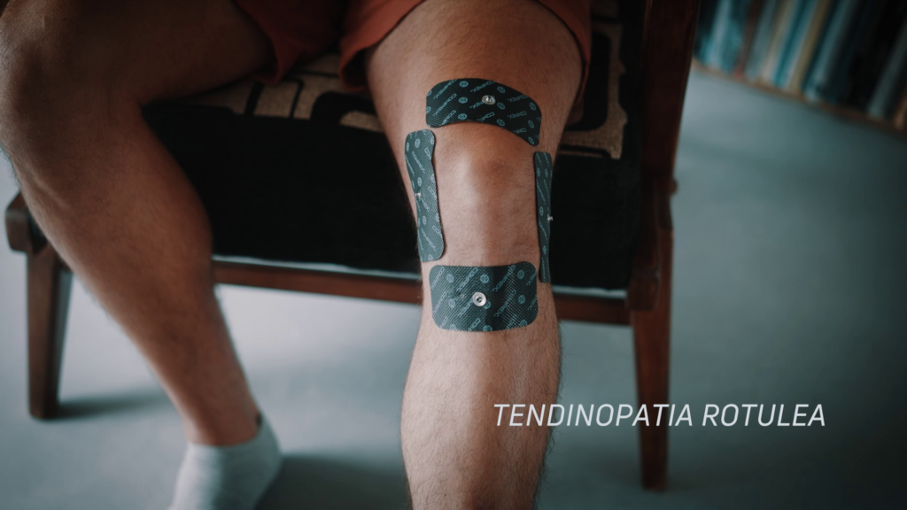 tendinopatia rotulea e TENS