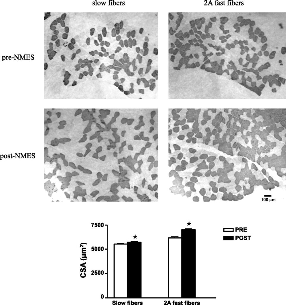biopsia muscolare che mostra i cambiamenti nelle fibre dopo l'elettrostimolazione