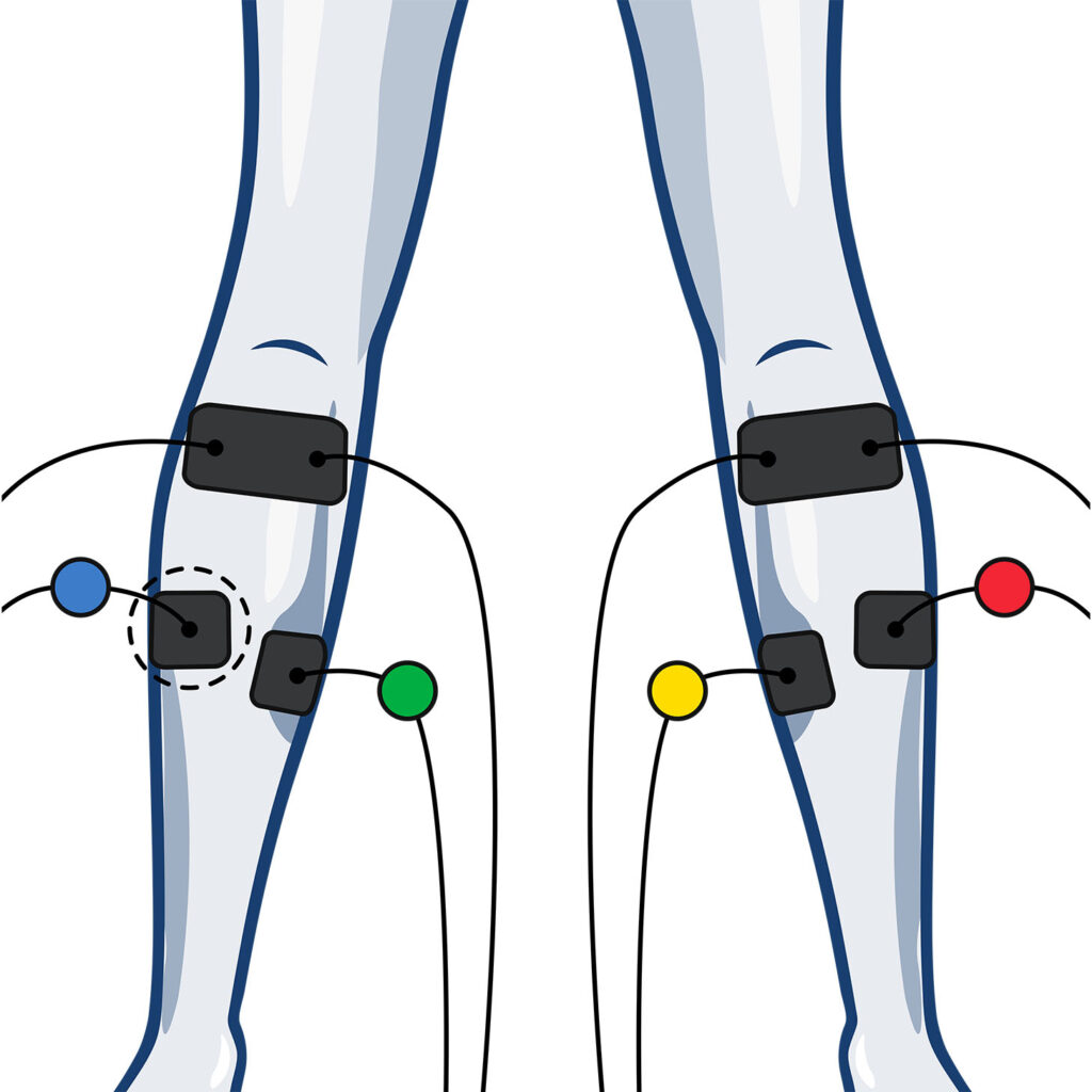Wired Calf Electrode Placement